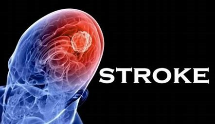 Ini Kata Dirut RSPON: Kendalikan Faktor Risiko Cegah Agar Tidak Terkena Stroke