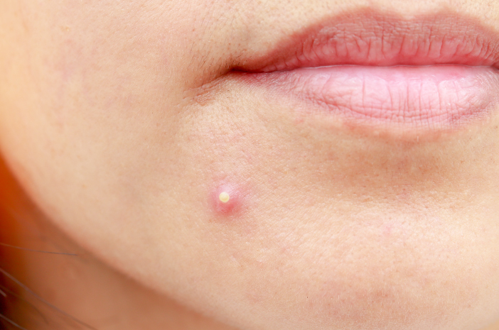 Usir Jerawat dengan Essential Oils