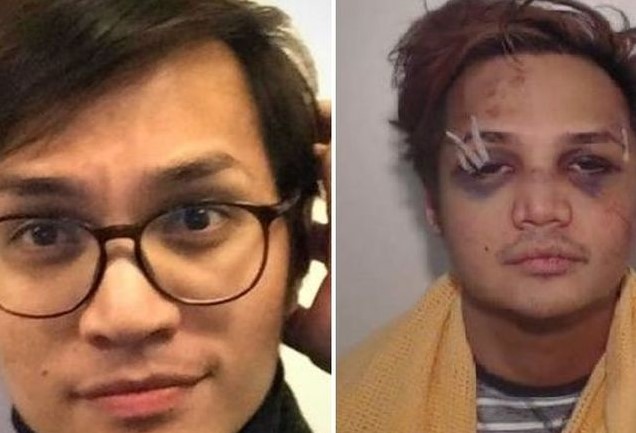 Ini Foto Predator Reynhard dengan Muka Lebam