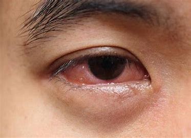 Cara Mengatasi Mata Bengkak Akibat Penuaan Secara Alami dan Tokcer