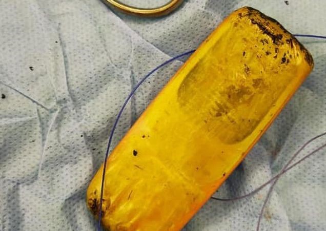   Perutnya Suka Sakit, Pria di Mesir Telan Ponsel Nokia 3310