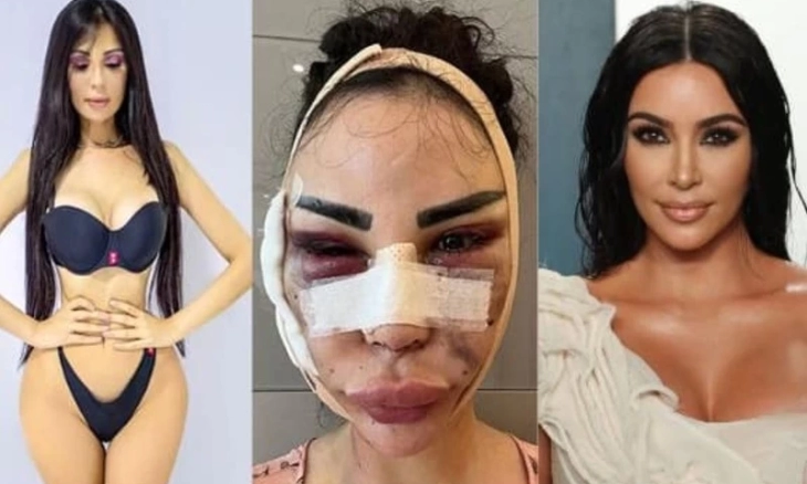 Menyesal, Model Asal Brazil Ini Habiskan 9 Miliar untuk Mirip Kim Kardashian