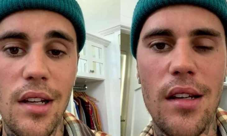 Virus Ini Membuat Separuh Wajah Justin Bieber Lumpuh