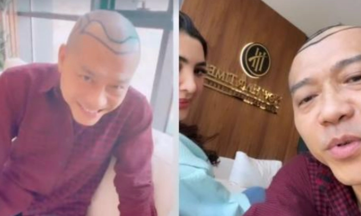 Anang Hermansyah: Seumur Hidup 2 Kali Botak Saat Lahiran dan Sekarang