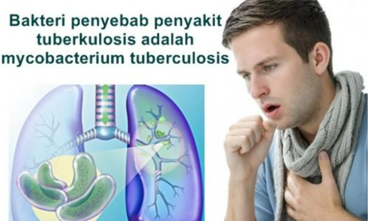 Jelang Hari Tuberkulosis, Wapadai Covid-19 dan TBC Bisa Serang Tubuh Bersamaan