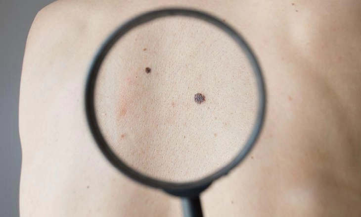 Ini Dia Perbedaan antara Tahi Lalat Normal dan Gejala Melanoma