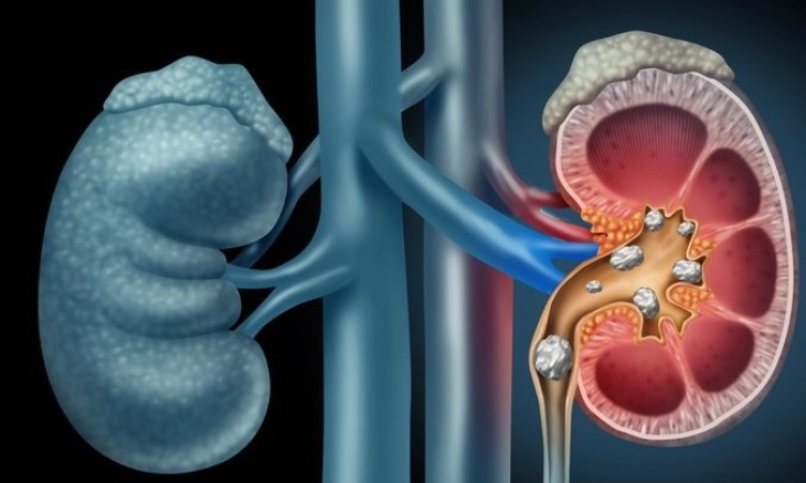 Kenali Gejala Batu Ginjal yang Harus di Waspadai