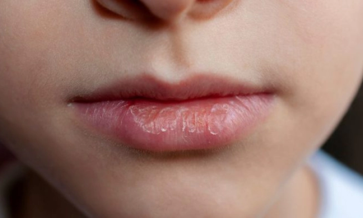 Cara Mudah Merawat Bibir Kering dan Pecah-pecah