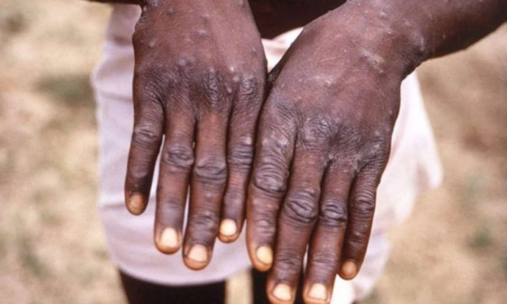 Kasus Cacar Monyet Dikonfirmasi di Inggris, Ketahui Gejala dan Pengobatannya