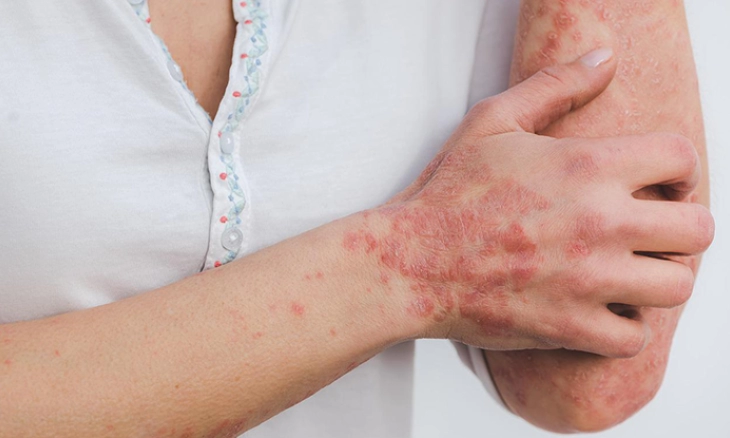 ICMR: 3 dari 5 Kasus Cacar Monyet di Delhi tidak Mengungkapkan Hubungan Homoseksual