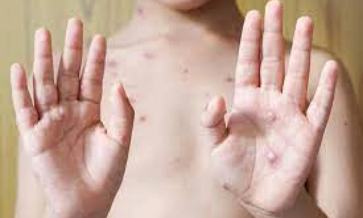 Wabah Cacar Monyet: PBB Sebut 