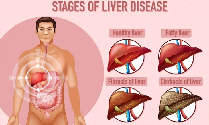 Masyarakat Diminta Waspada Terhadap Hepatitis Akut