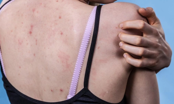 Jangan Dispelekan, inilah 6 Penyebab Terbentuknya Jerawat di Punggung