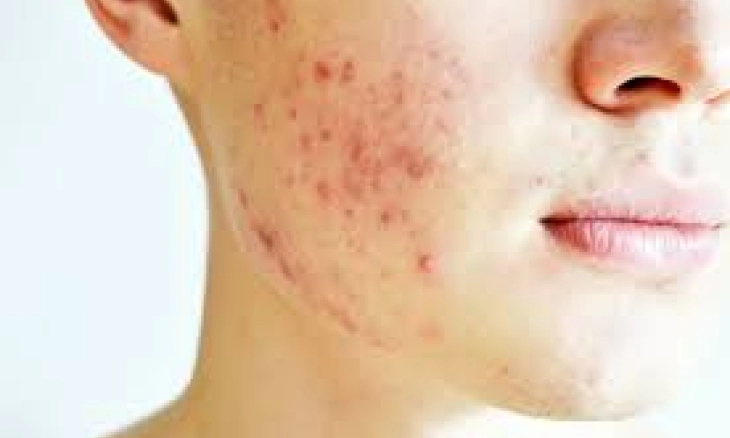 Kenali Penyebab Jerawat di Usia 30-an dan 40-an