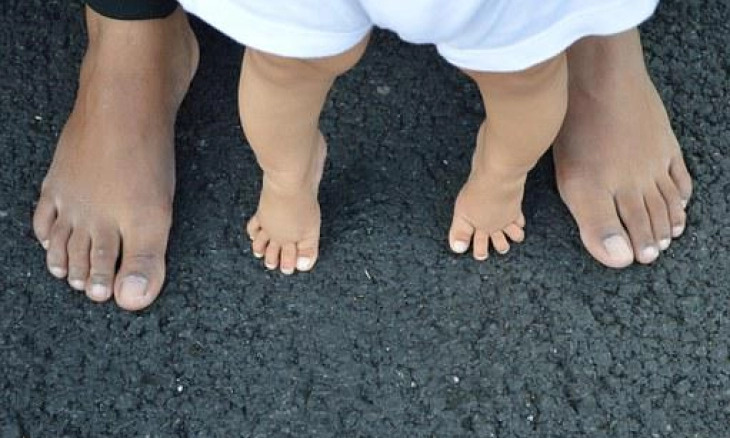 Penyebab dan Cara Mencegah Kaki O Pada Bayi 