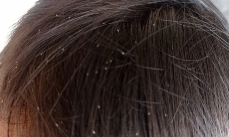 Hilangkan Kutu Rambut dengan Mouth Wash