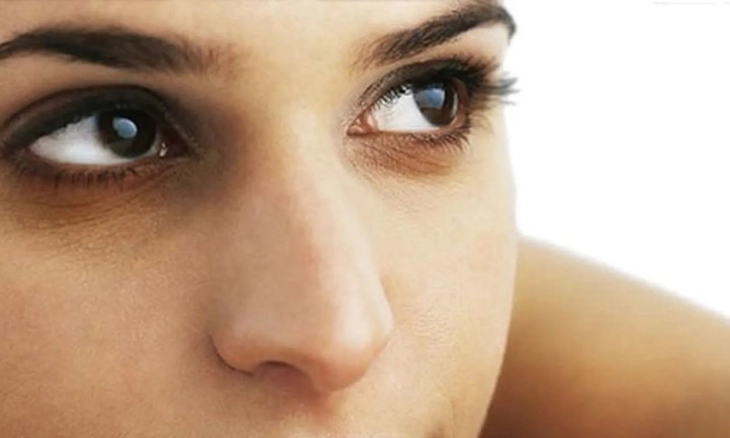 Coba 6 Cara Alami Ini untuk Mengatasi Lingkaran Hitam di Bawah Mata