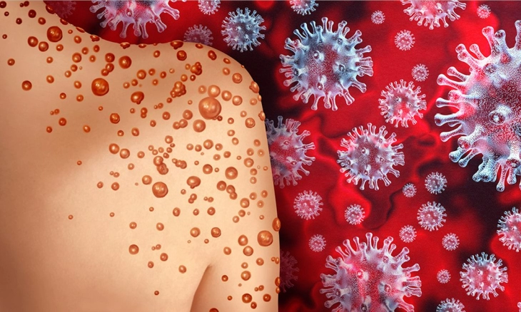 Kasus Cacar Monyet Meningkat, Kebanyakan Homoseksual yang Terinfeksi