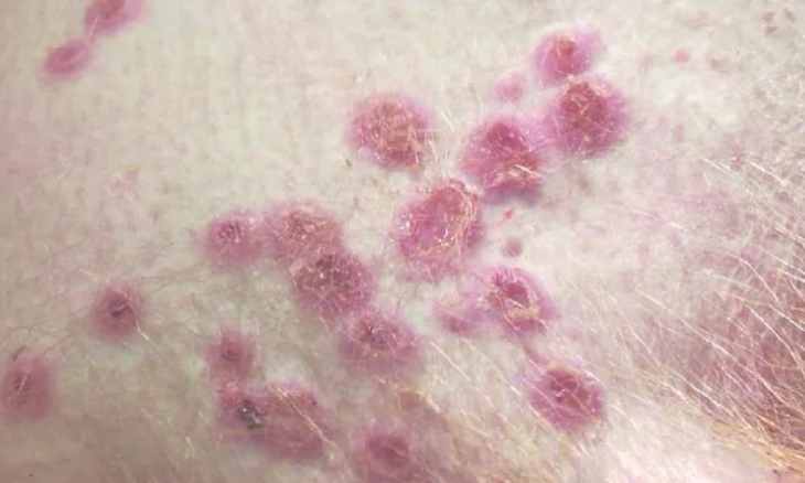 Virus Cacar Monyet Terdeteksi di 23 Negara dan Lebih dari 250 Kasus