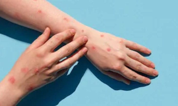 Monkeypox, Tidak Ada Alasan untuk Panik